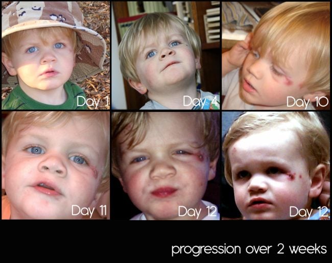 Toddler Cold Sore progression picture. Day 1 to Day 12